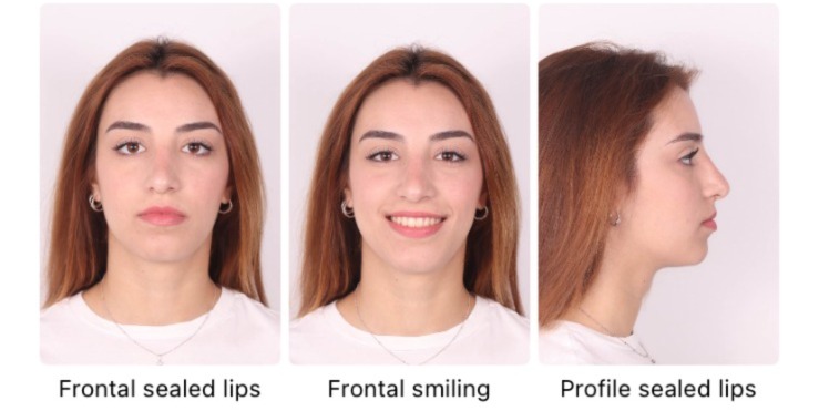 Contoh Foto Frontal Sealed Lips
